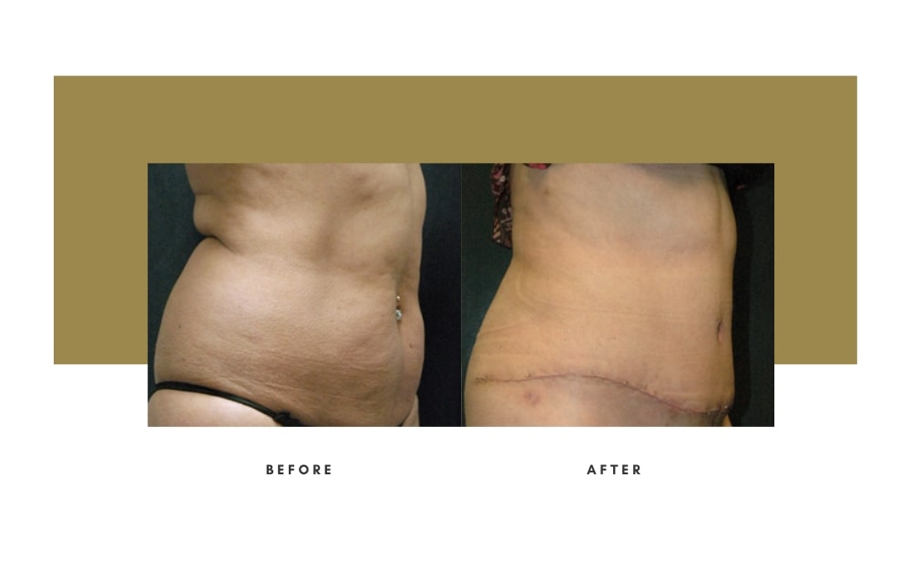 Abdominoplasty Beverly Hills Julie Edween D.O.