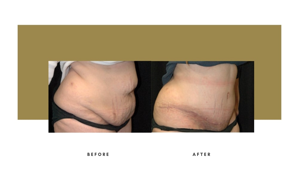 Abdominoplasty Beverly Hills Julie Edween D.O.