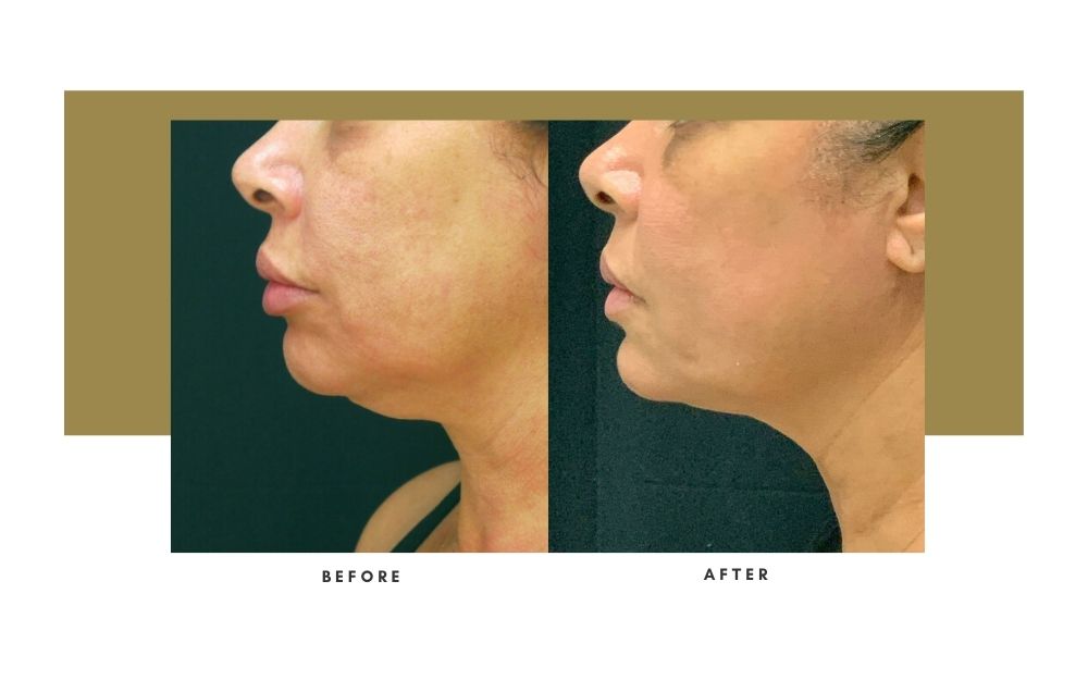 NonSurgical Facelift Beverly Hills Julie Edween D.O.