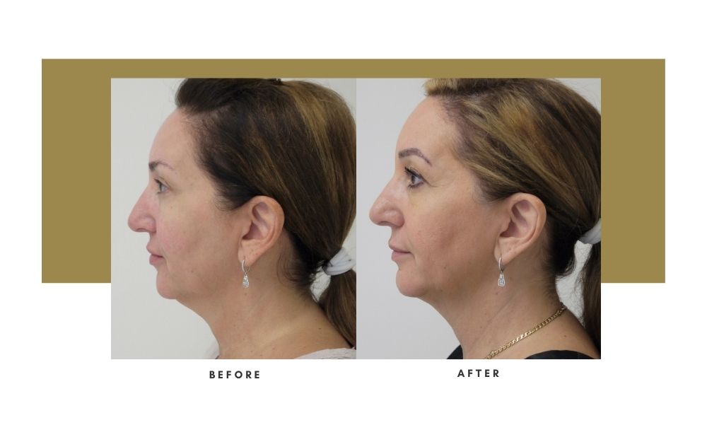 NonSurgical Facelift Beverly Hills Julie Edween D.O.