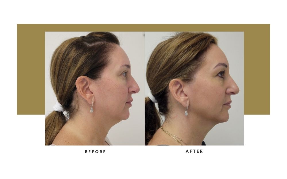 NonSurgical Facelift Beverly Hills Julie Edween D.O.