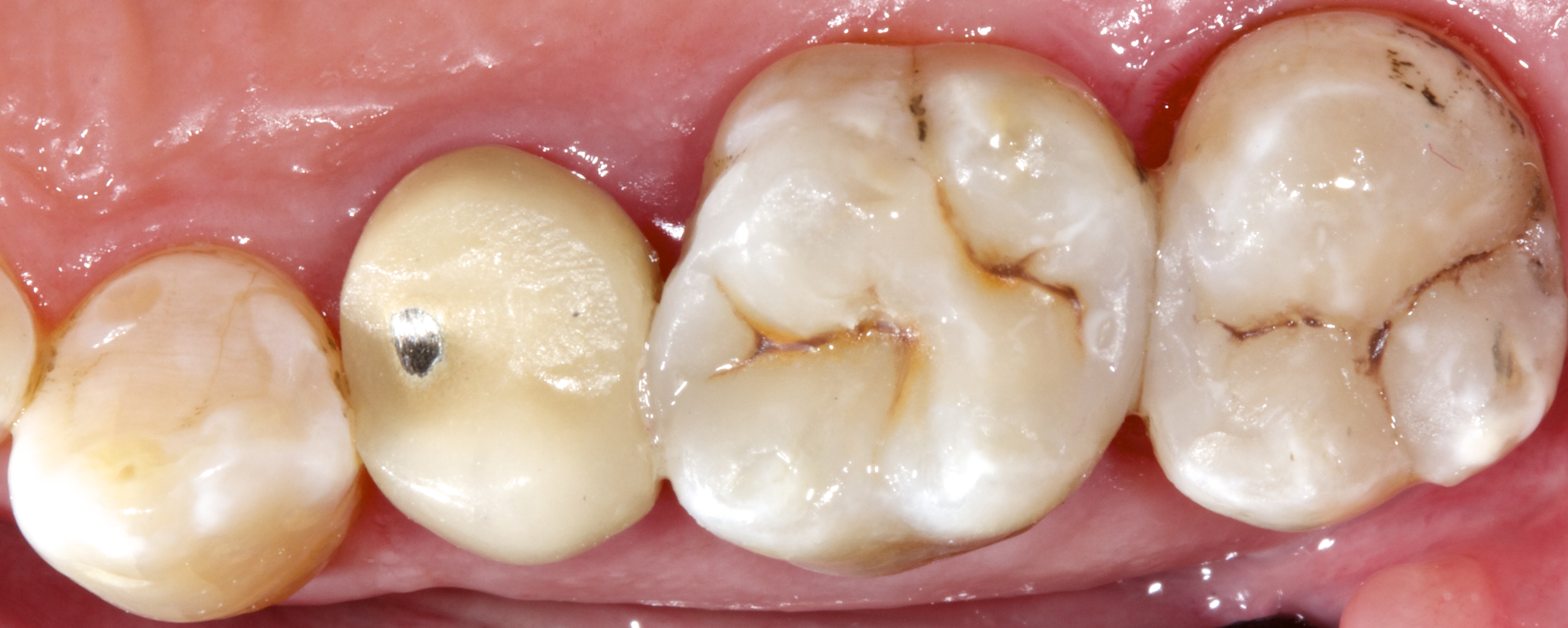 White Fillings gallery Richard Field