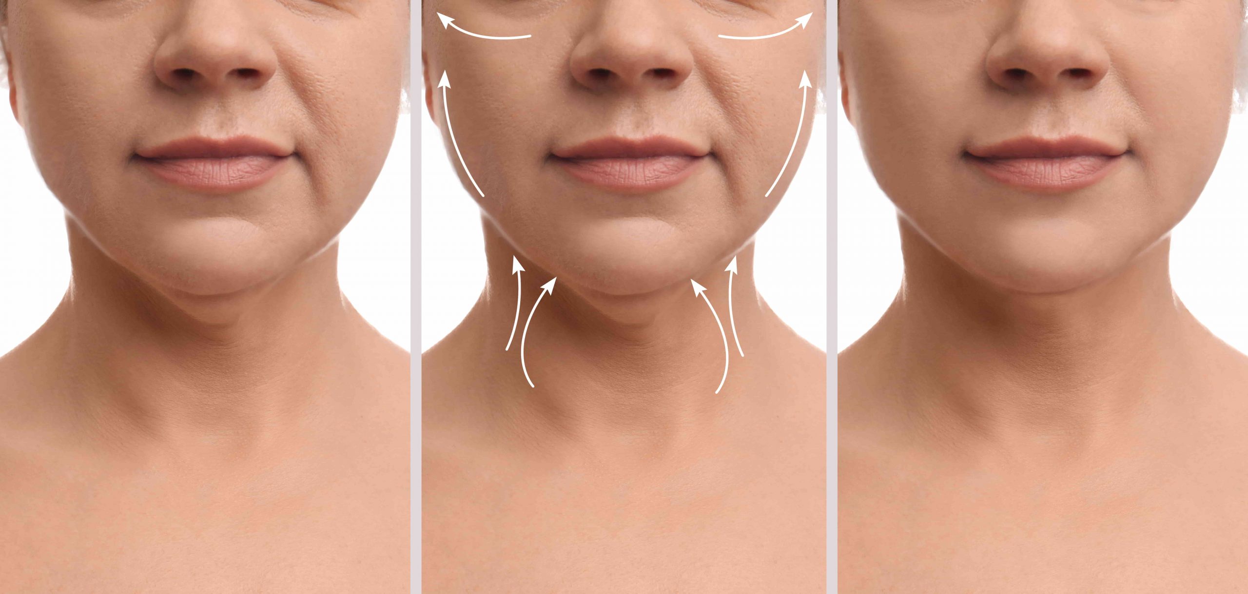 Facelift Vs. Neck Lift Which One Is Better? Suntrics