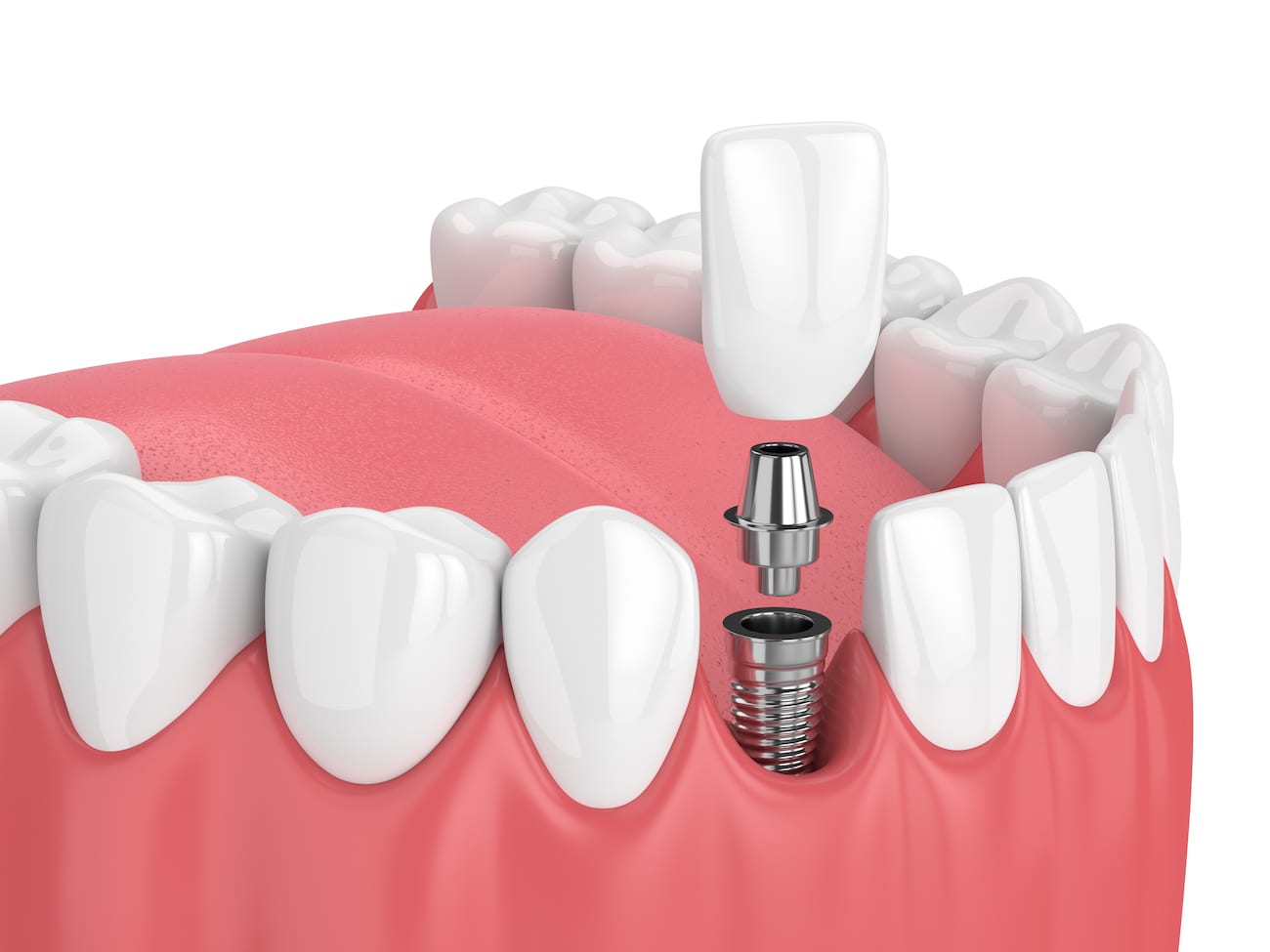 Single Tooth Dental Implant Lexington KY Tooth Implant