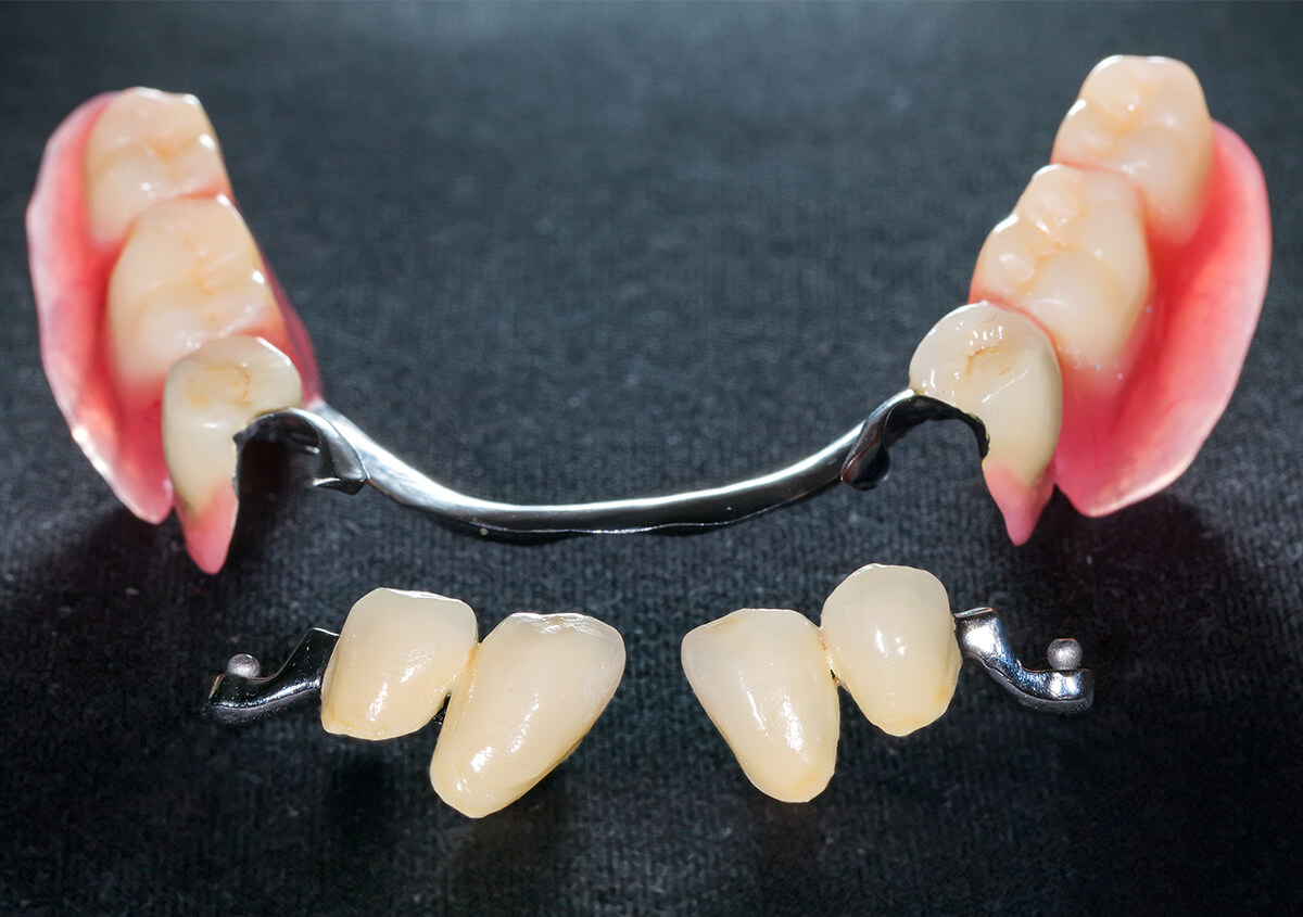 Partial Dentures Battle Creek MI Replace Missing Front Tooth