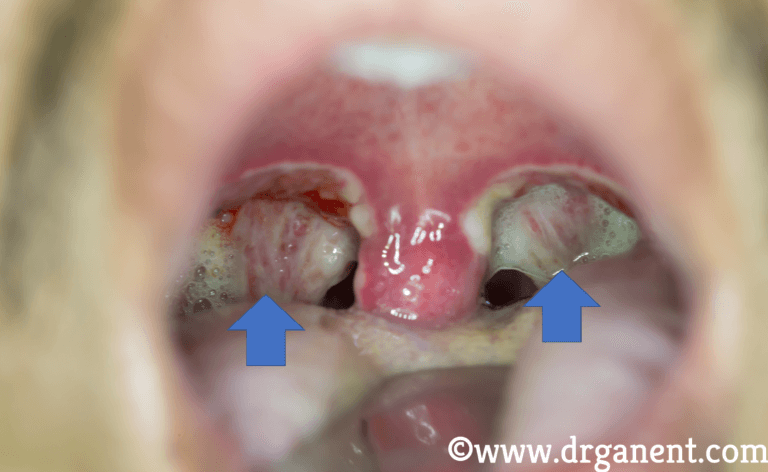 How Much Does It Cost To Get Tonsils Removed In Canada