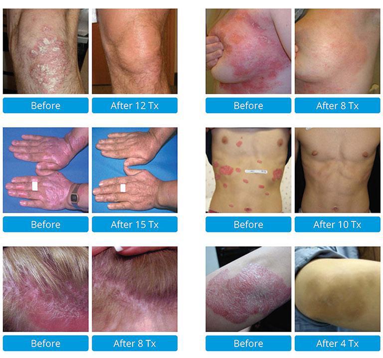Psoriasis / Vitiligo Laser Treatment in Brooklyn, NY Dr. Ghatan