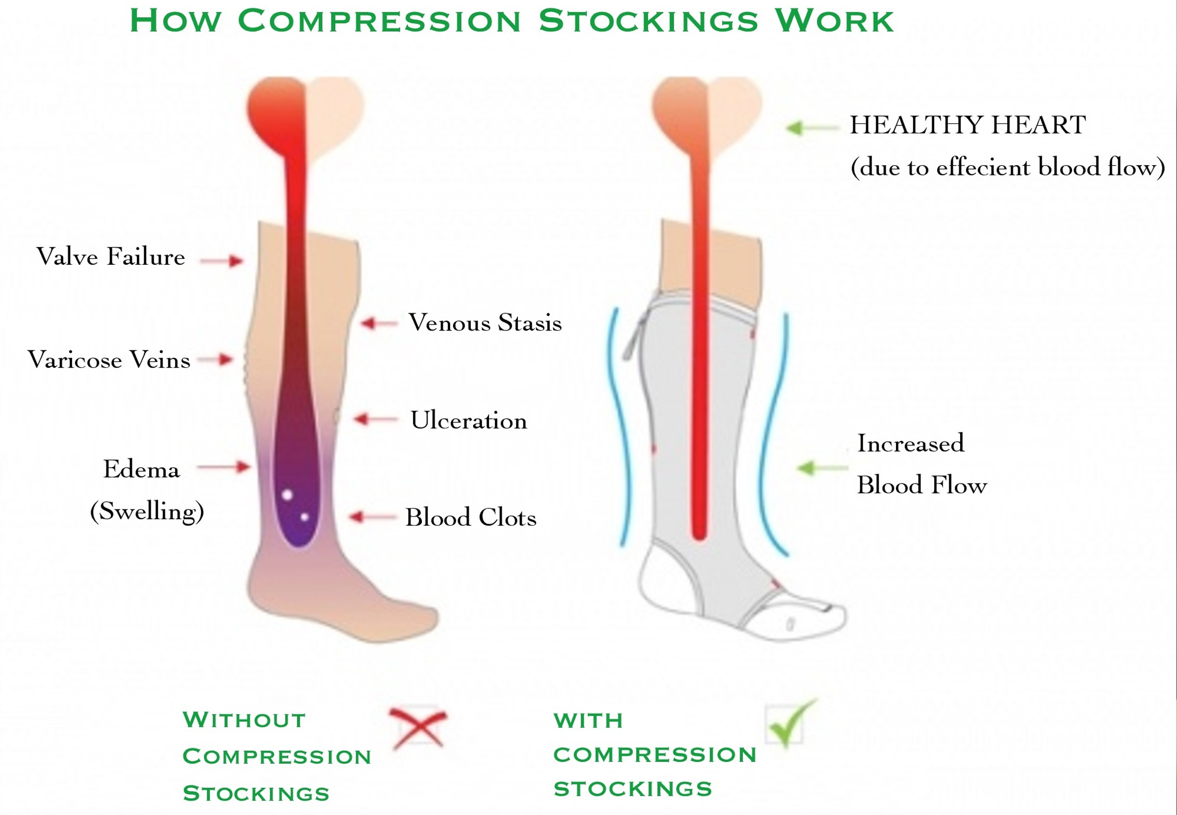 Compression Hosiery Gidda Medical Wellness