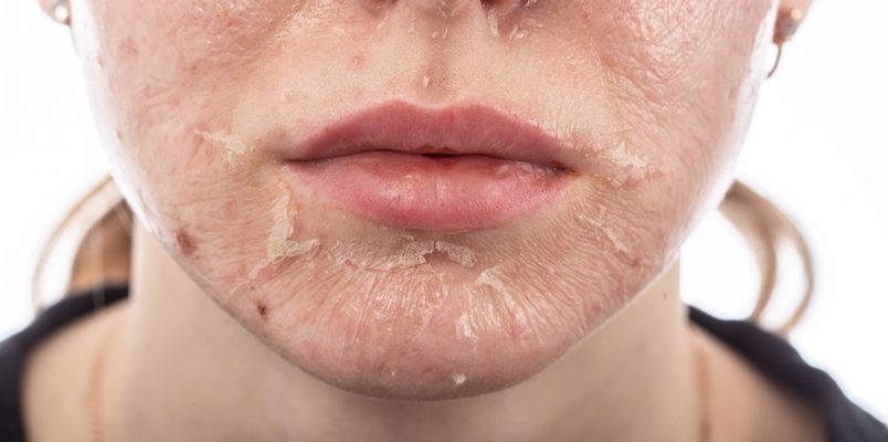 Skin Rashes Associated with COVID19 Coronavirus
