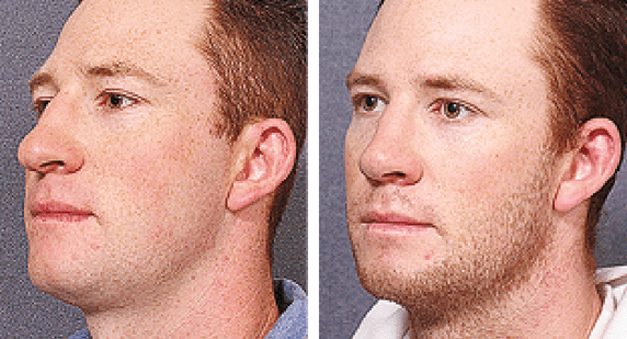 Male Rhinoplasty Or Male Nose Jobs