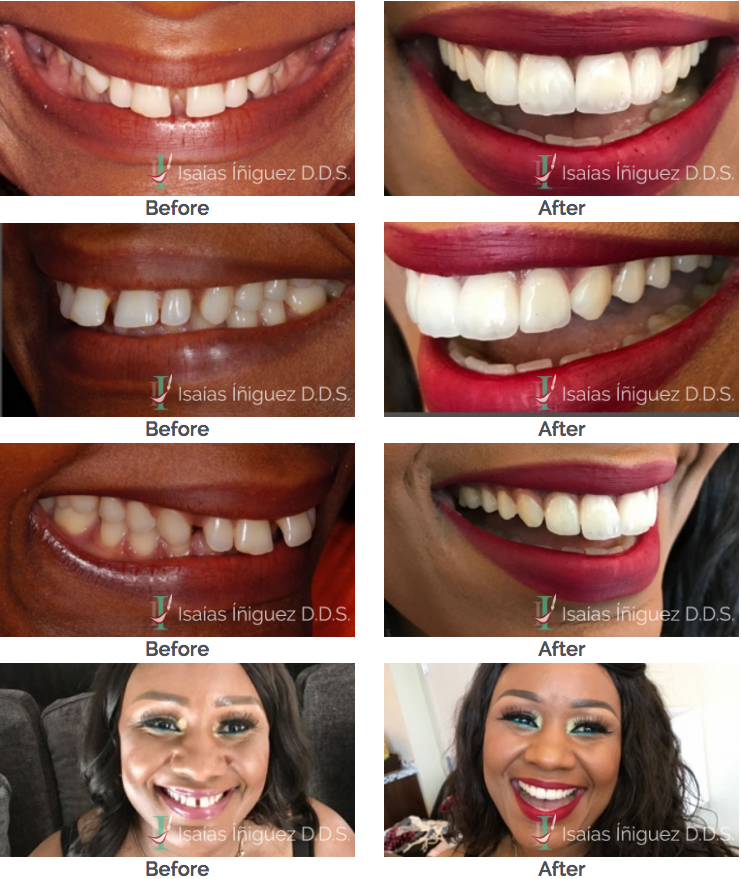 Featured Dental Cases in Los Algodones Mexico