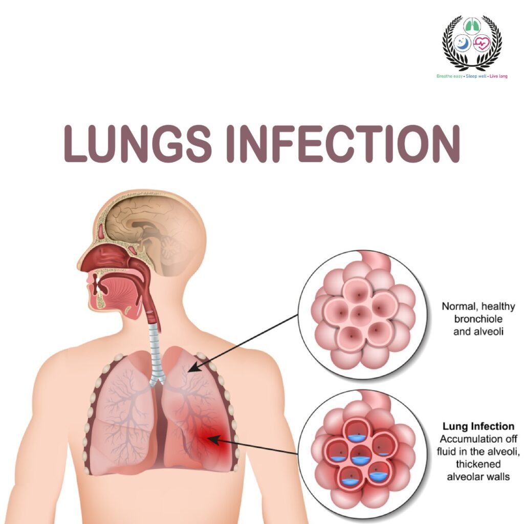 Lung Infection Types, Symptoms, Treatment Guide