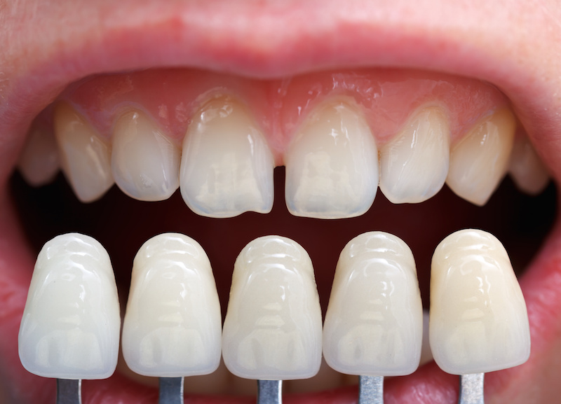 Dentist in Zionsville Explains the Dark Line under a Crown