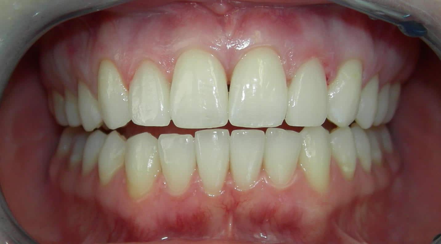 Cost of Dental Veneers These 4 Things Determine the Answer