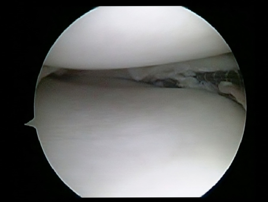 Arthroscopic Surgery for Meniscus Tears drkhalfayan Houston, Texas USA