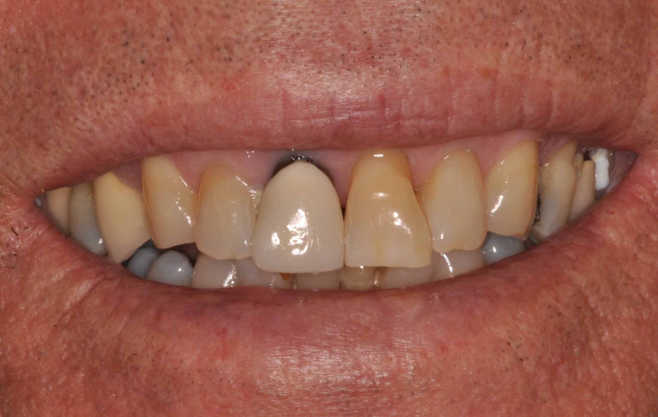 Porcelain Fused To Metal Crown Before And After