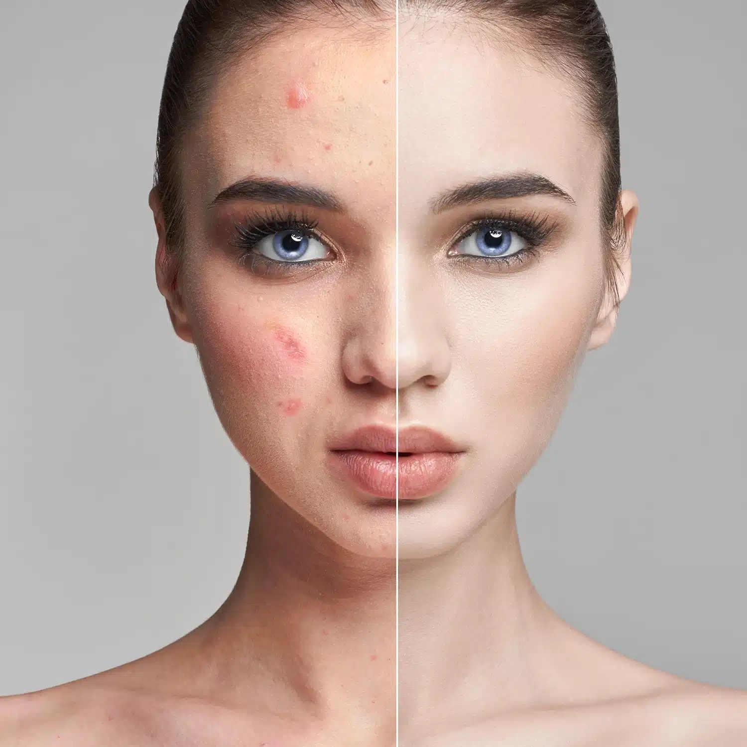 Akne und Aknenarben Scin Center Cassel