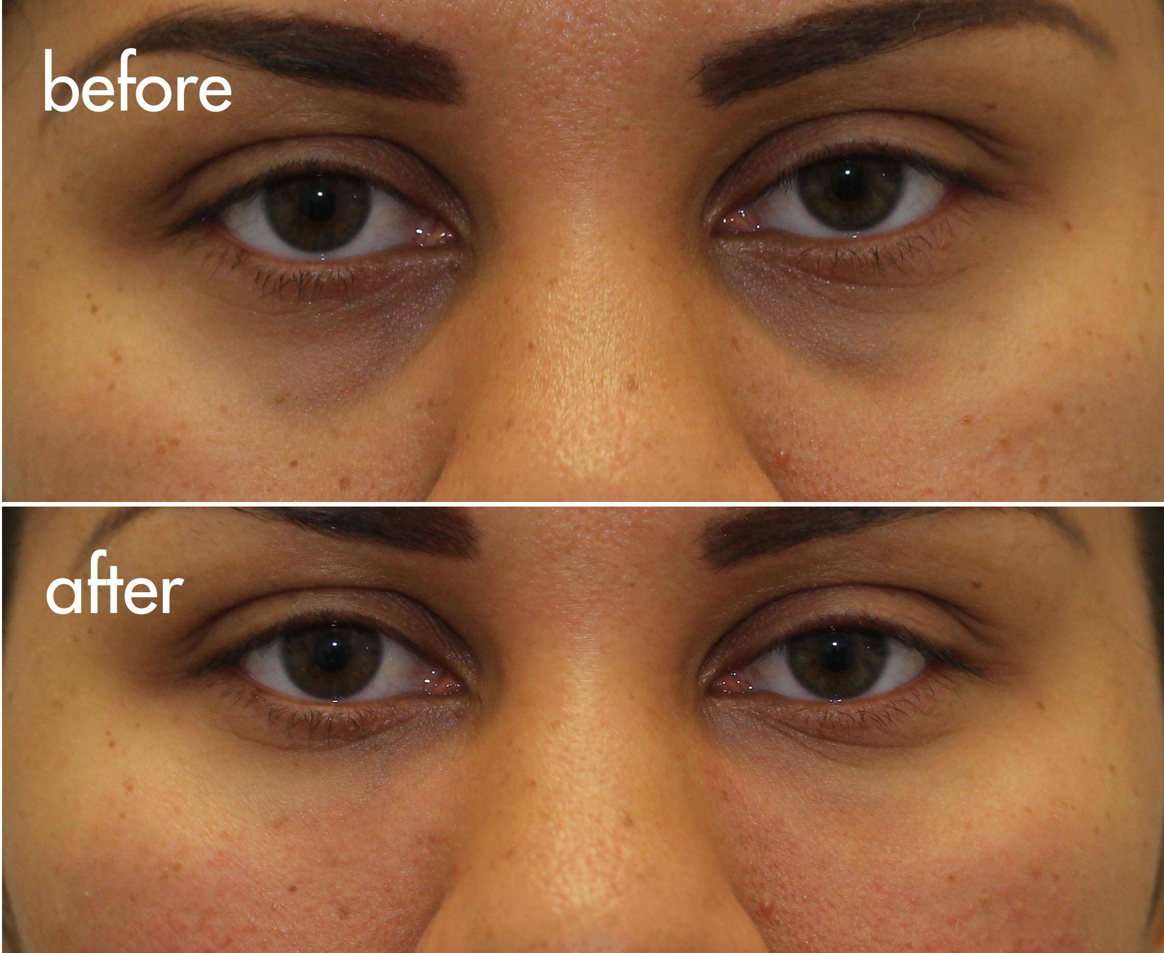 Cannula Tear Trough Filler Dr. Brett Kotlus, Cosmetic Oculoplastic