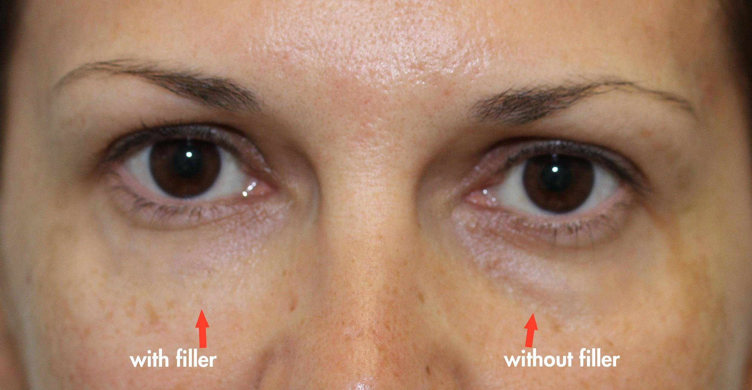 Cannula Tear Trough Filler Dr. Brett Kotlus, Cosmetic Oculoplastic