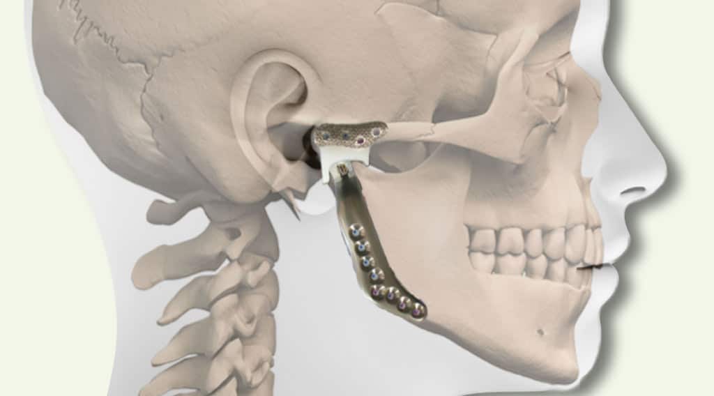Total Temporomandibular Joint (TMJ) Replacement Larry M. Wolford, DMD