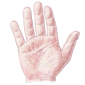 Handeczeem | Oorzaak En Behandeling | Drs Leenarts