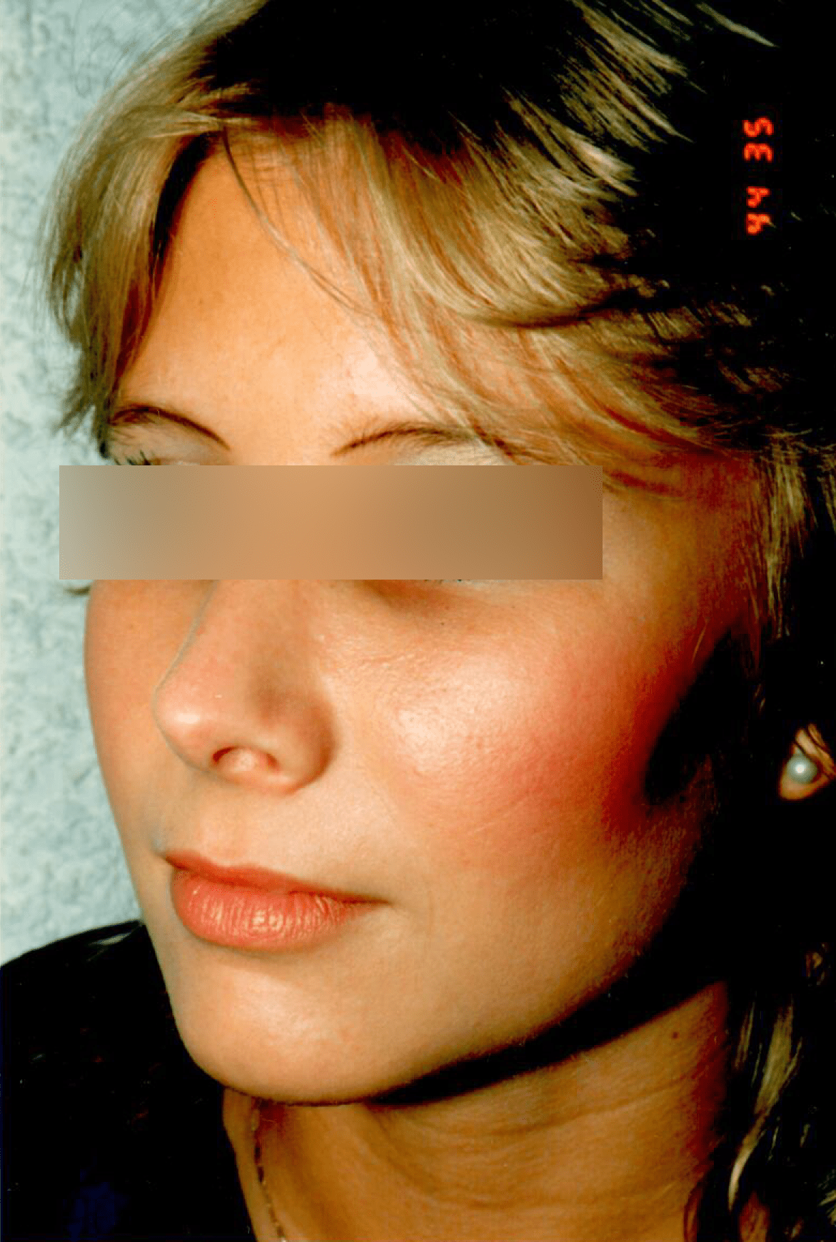Rhinoplasty Vancouver Cosmetic Surgery