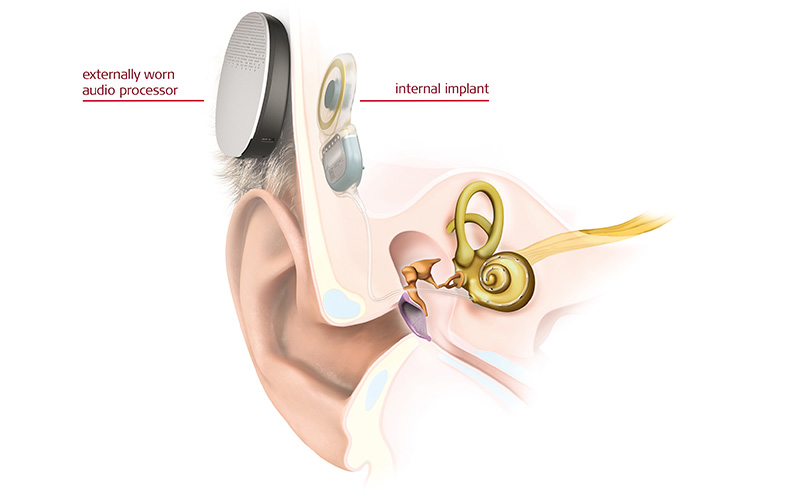 BAHS Hearing Aid & System In SG Dr. Lynne Lim ENT Hearing Centre