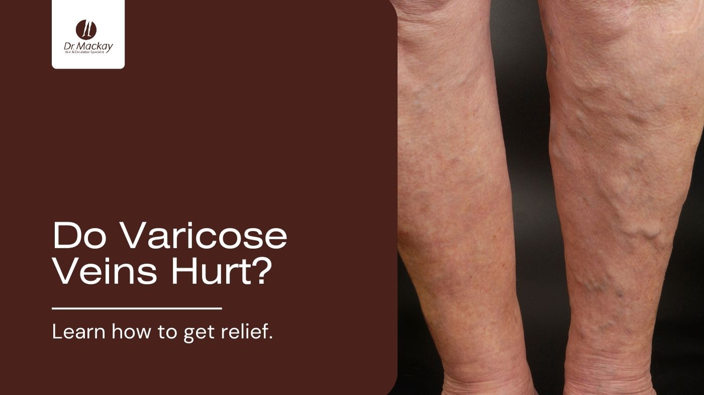 Do Varicose Veins Hurt? Learn How You Can Get Relief Dr.Mackay
