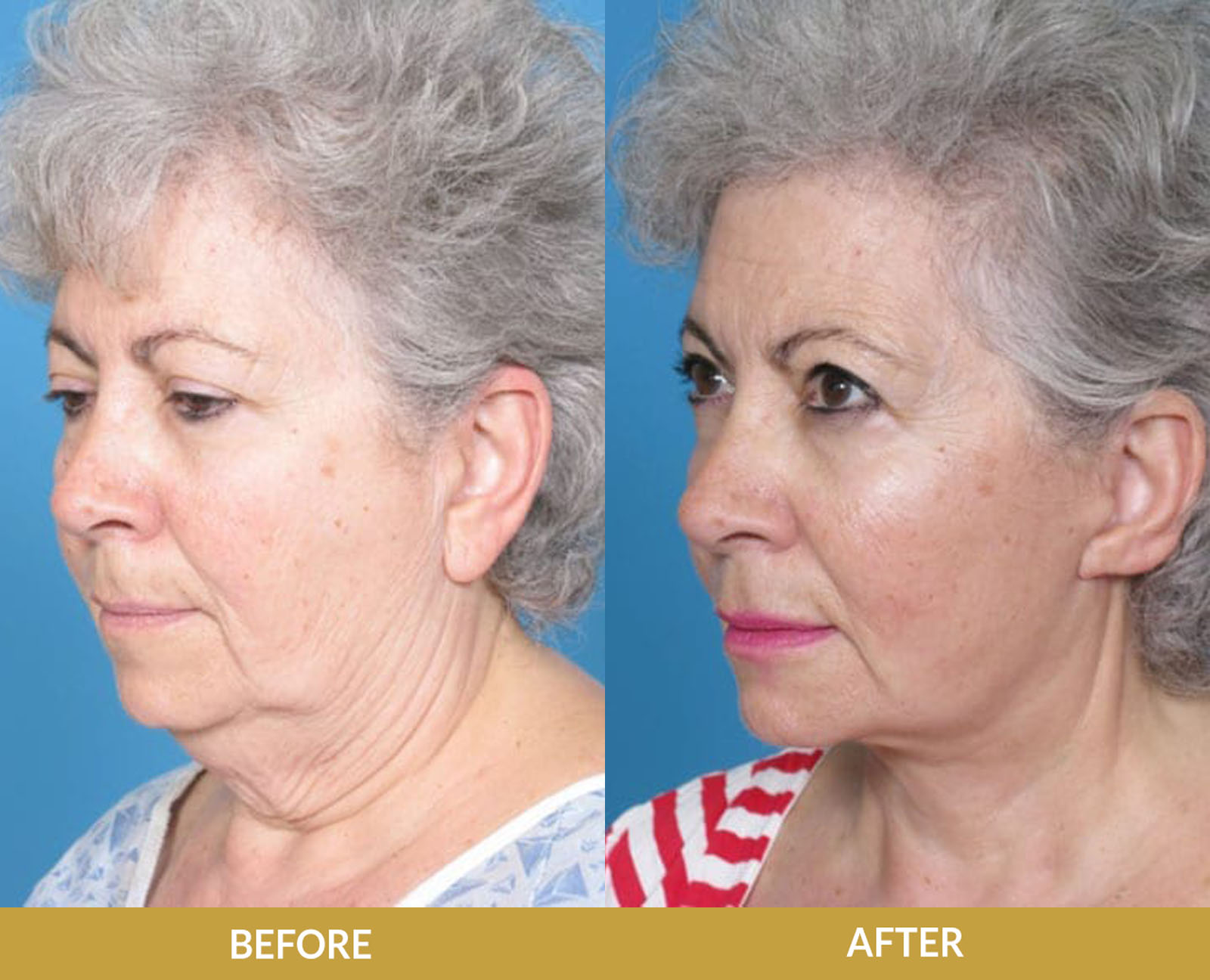 Before & After Sculptra Results