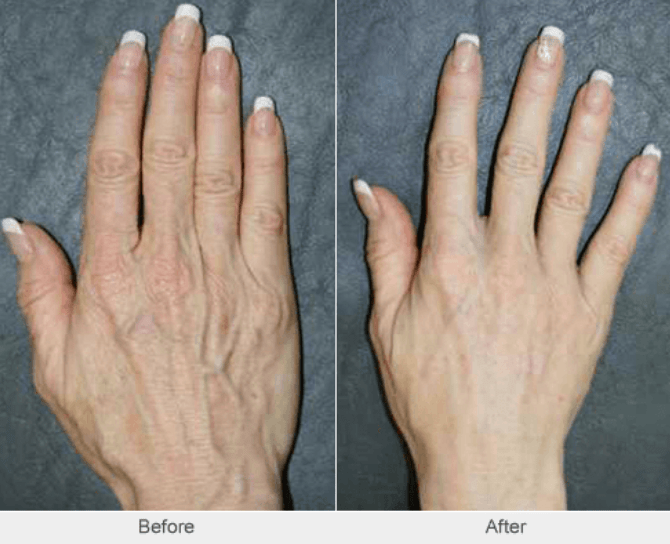 Hand Veins Dr Marek Sepiolo