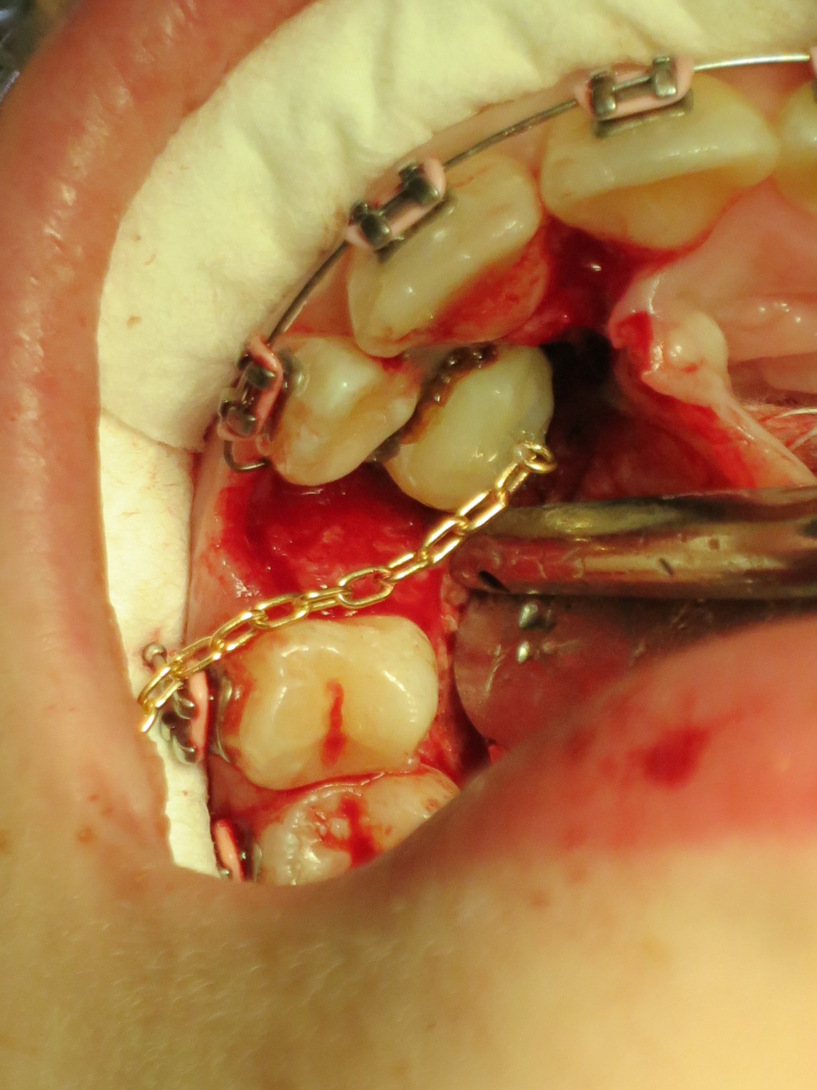 Impacted Canines Before and afters Dr. Nima Massoomi