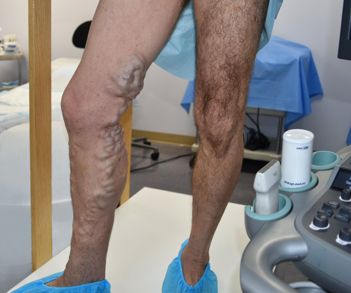 Endovenous ablation of varicose veins by radio frequency treatment