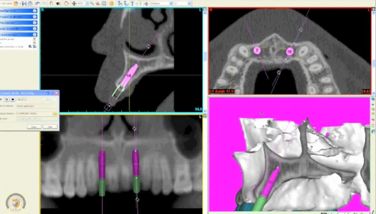 Dental Implant Imaging in Eatontown, NJ Dr. Marc E. Gordon