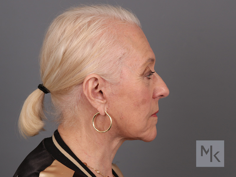 Facelift Before and After 11 Dr. Michael Kim