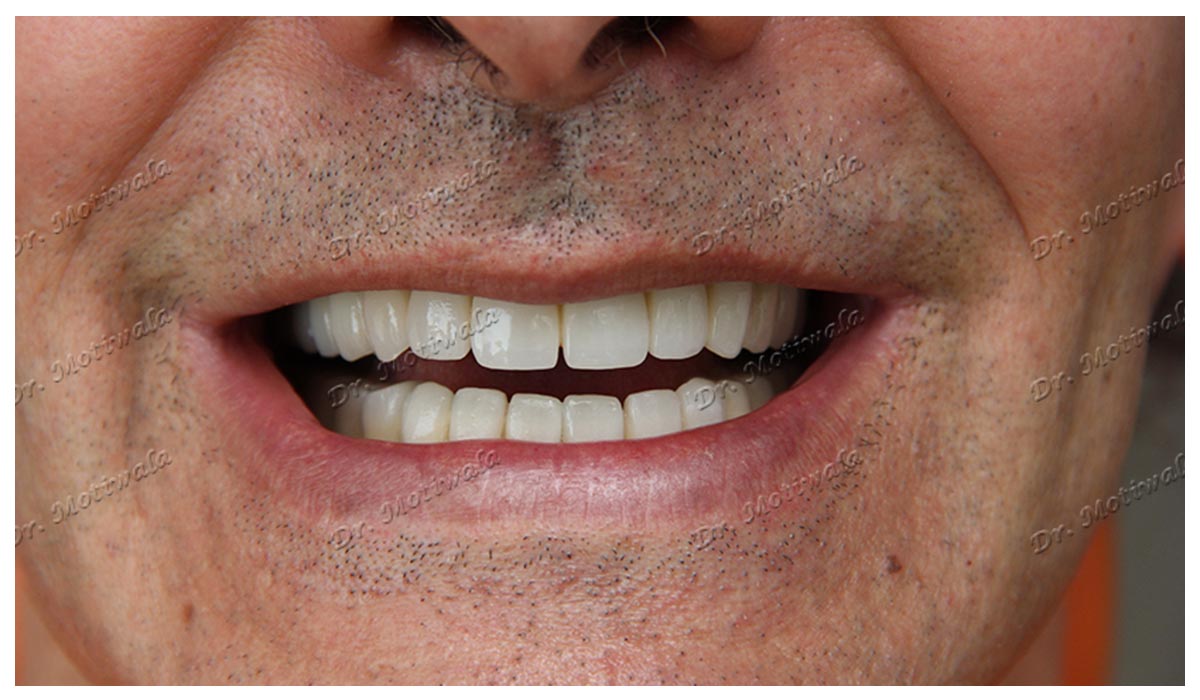 Full Mouth Dental Implants Before and After Dental Clinic