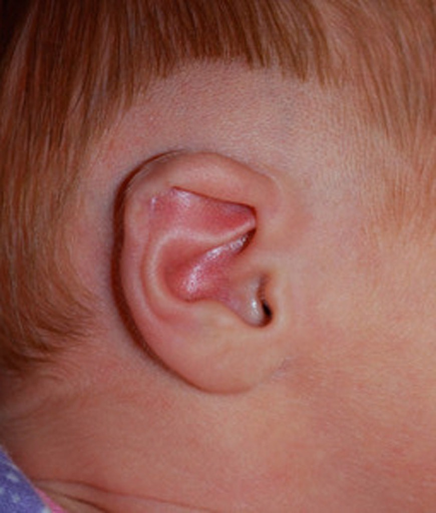 Baby Ear Deformities Dr. Onganlar Baby Ear Molding