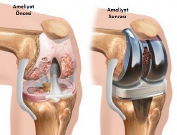 Microprocessor-controlled Prosthetic Knees Access.