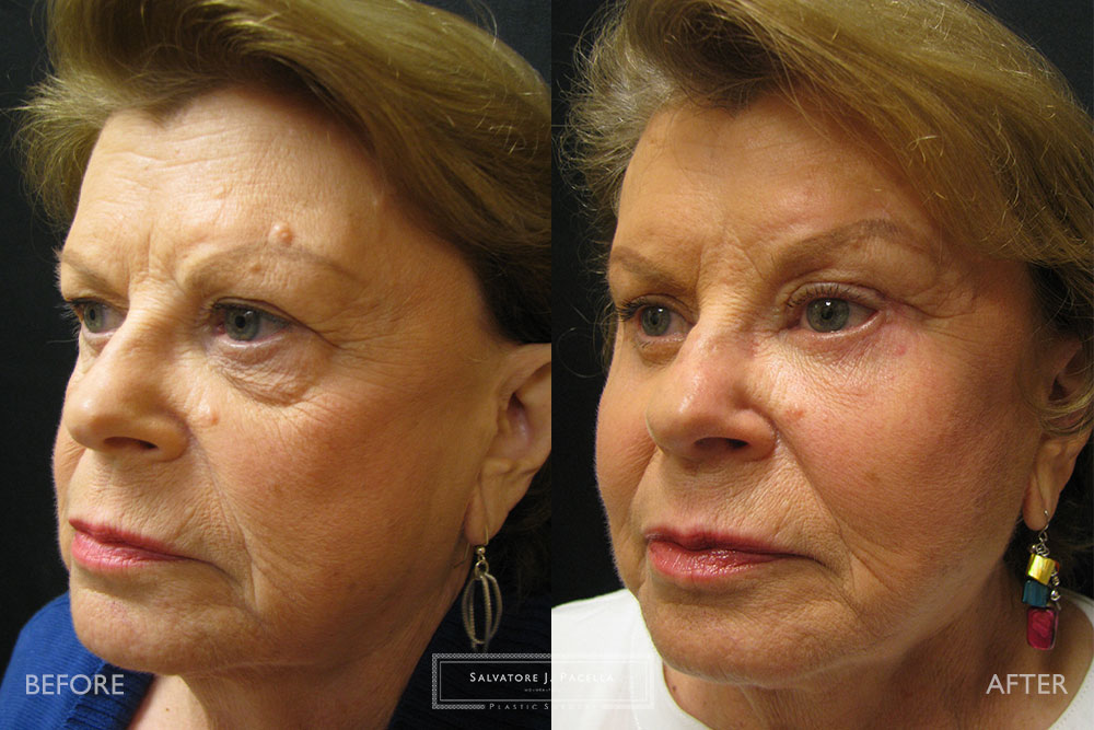 Cosmetic Eye Patient 8784 Salvatore J. Pacella, BoardCertified
