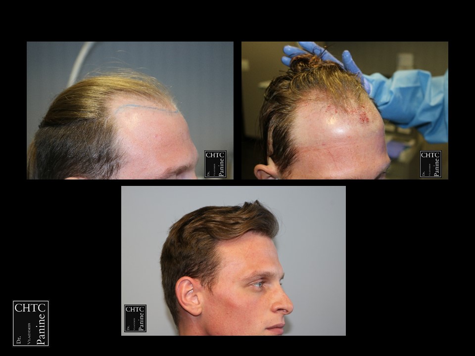PANINE, MD CHICAGO HAIR TRANSPLANT CLINIC 2,814 Graft