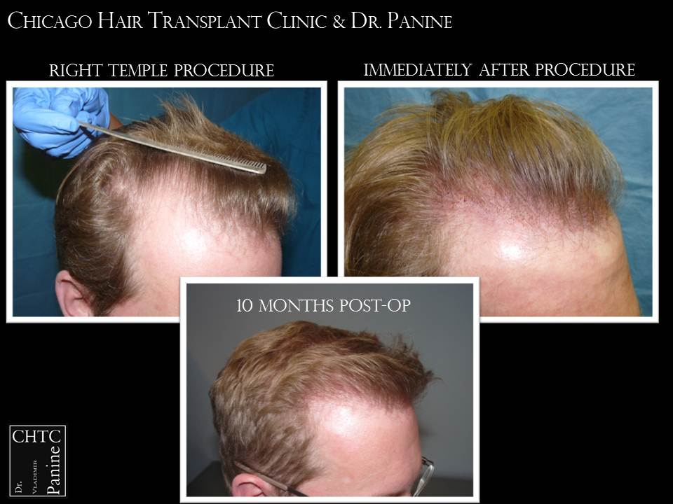 Dr. Panine Chicago Hair Transplant Clinic 3,334 grafts