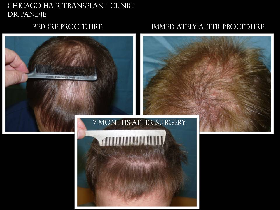 Dr Panine Hair Transplant PANINE, MD & CHICAGO HAIR TRANSPLANT CLINIC