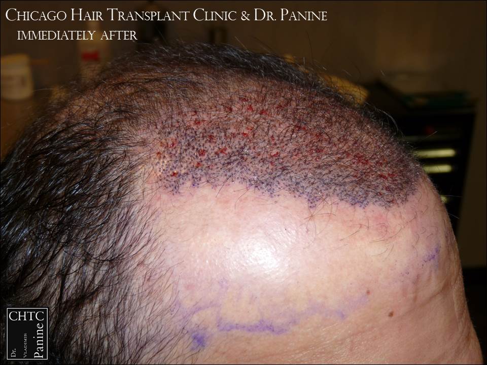 Tyrolean Lodge Hair Restoration Chicago