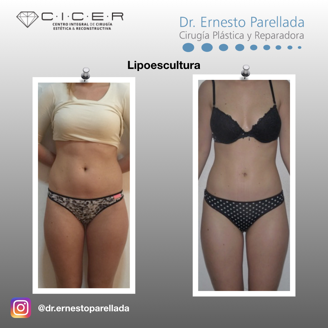 Cirugía De Contorno Corporal – Dr Parellada Cirujano Plastico