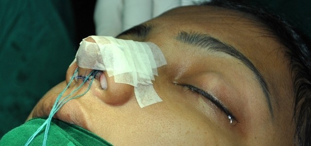 Where and How to get Rhinoplasty in Trivandrum, Kerala, India?
