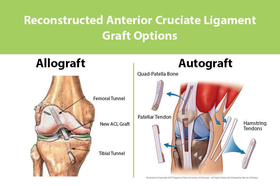 Choosing an ACL Graft what is your best option? Dr. Frank Petrigliano