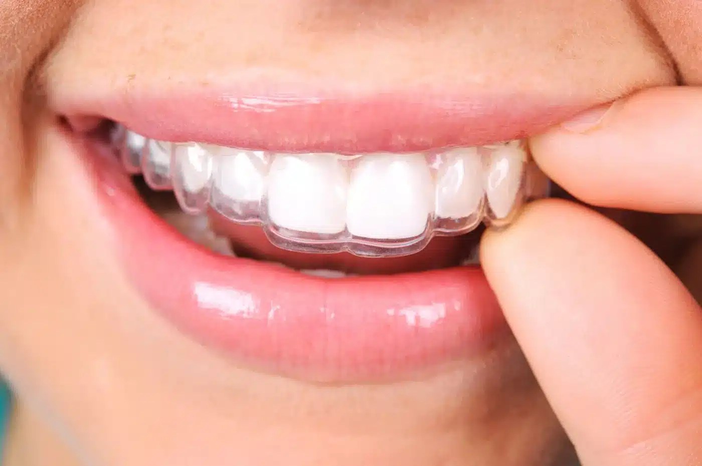 How Does Invisalign Work? Dr Pierre Dentistry