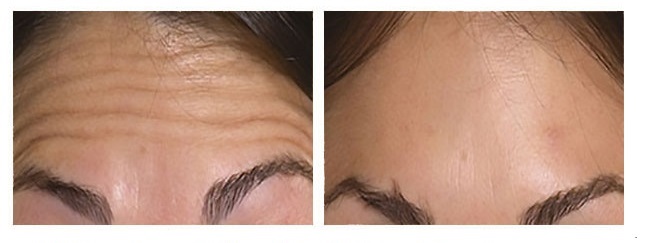 Before & After Botox Injection