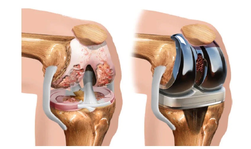 Best TKR Surgeon in Jaipur, Total Knee Replacement Surgery Jaipur