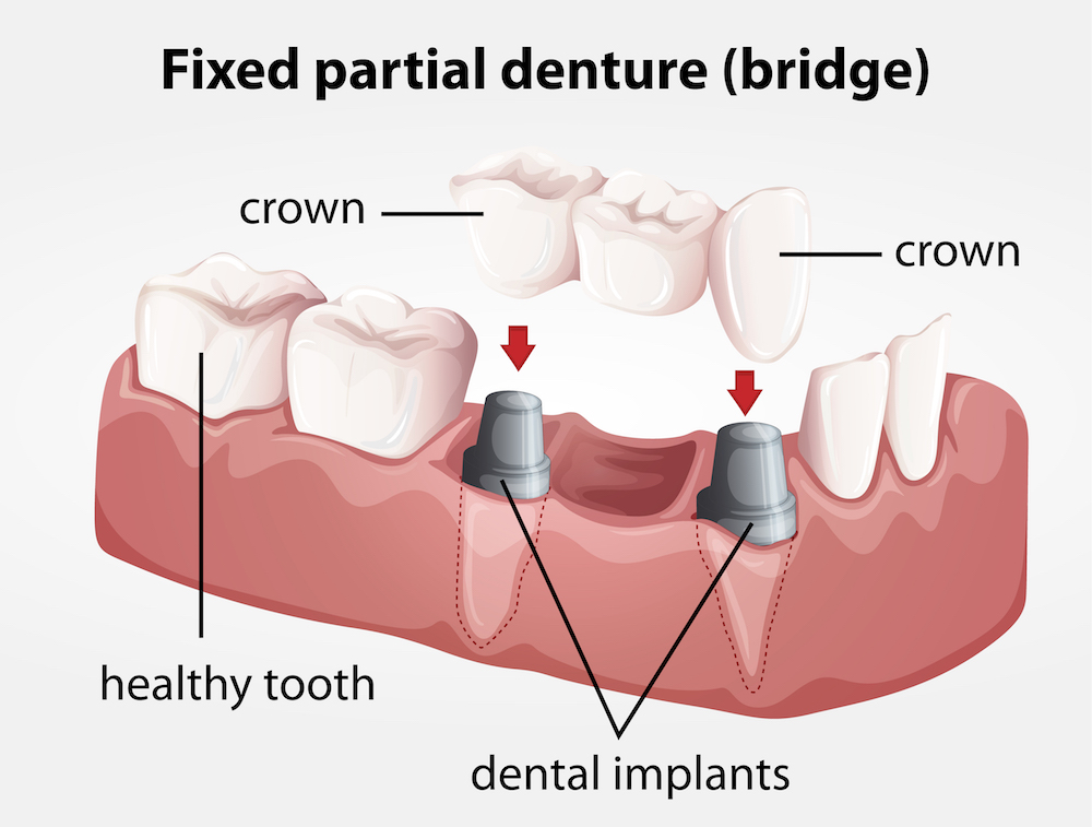 Dental Implants Consumer Guide Dr. David Rodrick Centennial CO