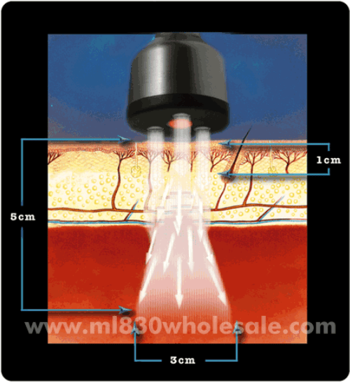 Cold Laser Therapy in Pasadena Family Chiropractic Wellness Center